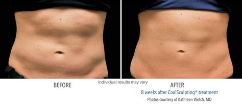 Cool Sculpting Hesperia Cool Sculpting Redlands Melt The Fat Away