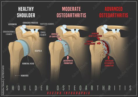 Shoulder Osteoarthritis Infographic Stock Vector Adobe Stock