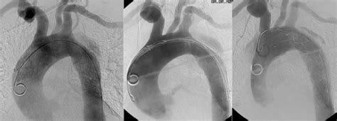 Retrograde Aortic Type A Dissection During Placement Of A Stent Graft