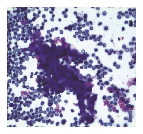 (a) 400x Romanowsky stain demonstrating epithelioid cluster delineating ...