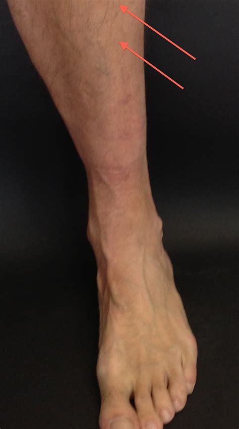 Can Anterior Compartment Syndrome Lead To Plantar Fasciitis Captions