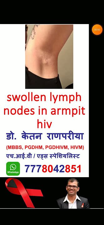 Swollen Lymph Nodes Groin Hiv