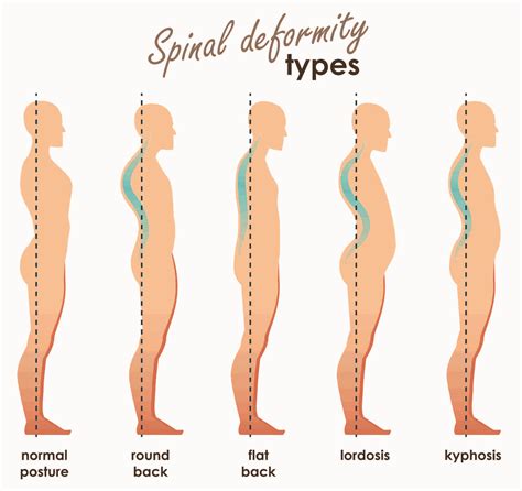 Loss Of Lumbar Lordosis