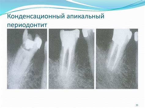 Острые и хроническое периодонтиты - online presentation