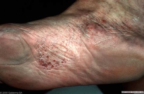 dyshidrotic eczema on feet - pictures, photos