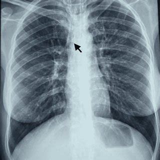 Posteroanterior Chest Radiograph Demonstrates Typical Features Of