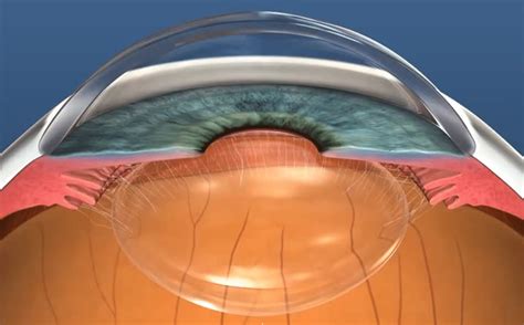 Selective Laser Trabeculoplasty (SLT) - Glaucoma Treatment | Dr Nathan Kerr