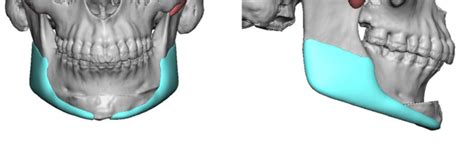 Plastic Surgery Case Study Female Jawline Reshaping With A Sliding