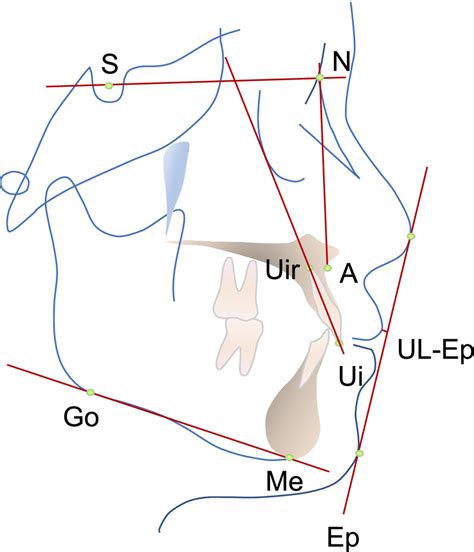 Cephalometric Landmarks And Indicators S Sella N Nasion A