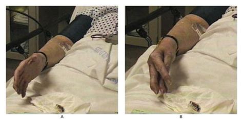 Positive Trousseau’s Sign In Hypocalcemia And Hypomagnesemia Carpal Spasms Occur By Occluding