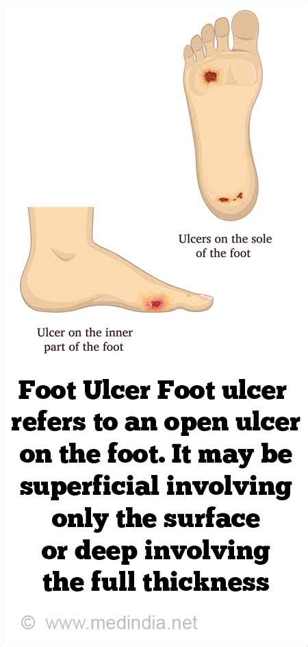 Types Of Ulcers On Foot Factory Sale Emergencydentistry