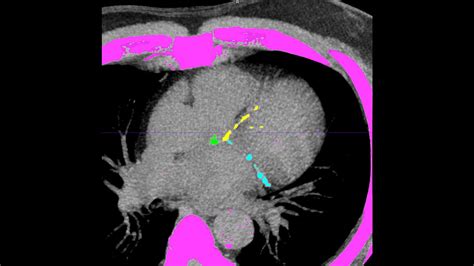 Time To Rethink The Calcium Scoring Workflow