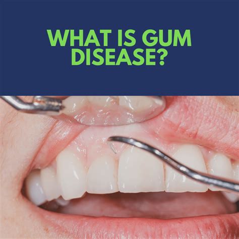 What Is Gum Disease Needham Bedford Franklin Ma