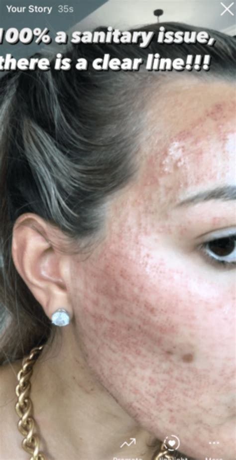 Microneedling Before And After Inflammation And Regret Case Study