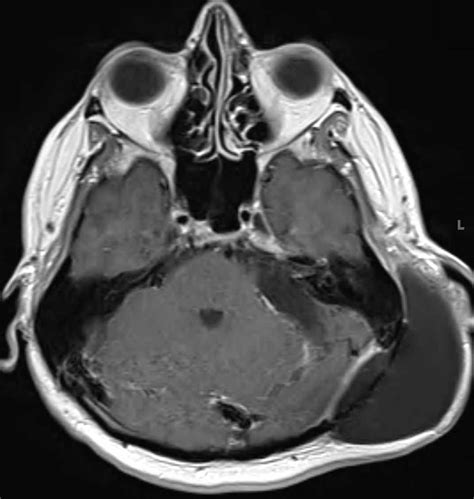 Pseudomeningocele - Neuro MR Case Studies - CTisus CT Scanning