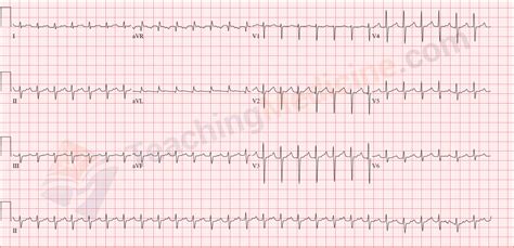 12 Lead ECG Sinus Tachycardia