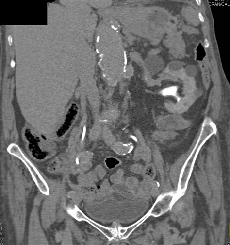 Metastases To The Right Adrenal Gland From Renal Cell Carcinoma