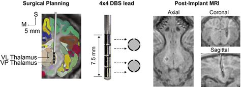 Figure 1 From Orientation Selective And Directional Deep Brain Stimulation In Swine Assessed By