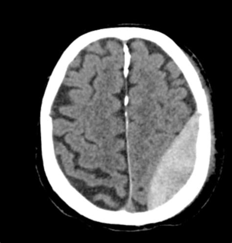 Epidurales H Matom Links Doccheck