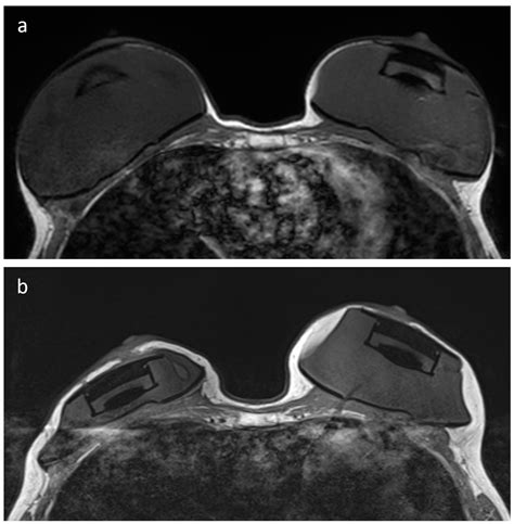 Jcm Free Full Text Mri Conditional Breast Tissue Expander First In