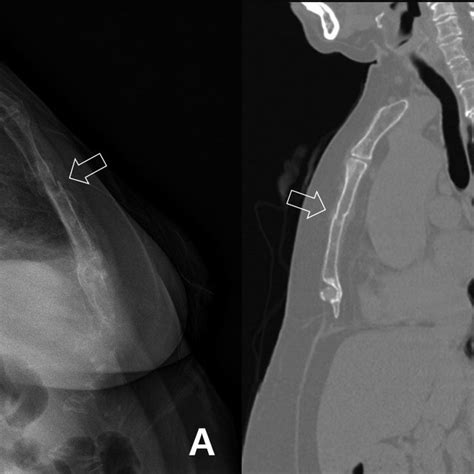 A Sternum Lateral Oblique X Ray B Sagittal Reconstruction Chest