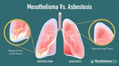 Mesothelioma Vs Asbestosis Types And Treatment Differences