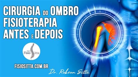 Ombro Cirurgia Bristow Latarjet Tratamento De Fisioterapia LuxaÇÃo PÓs