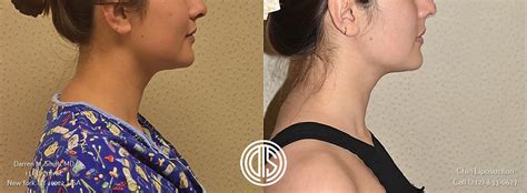 The Ultimate Guide To Submental Chin Liposuction In New York