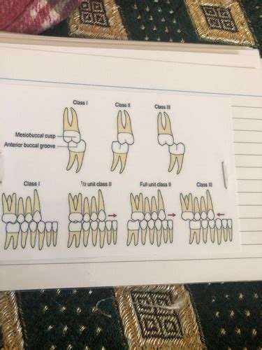 Malocclusion Flashcards Quizlet