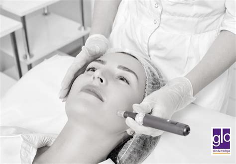 Microneedling 101 Glo Skin And Medspa