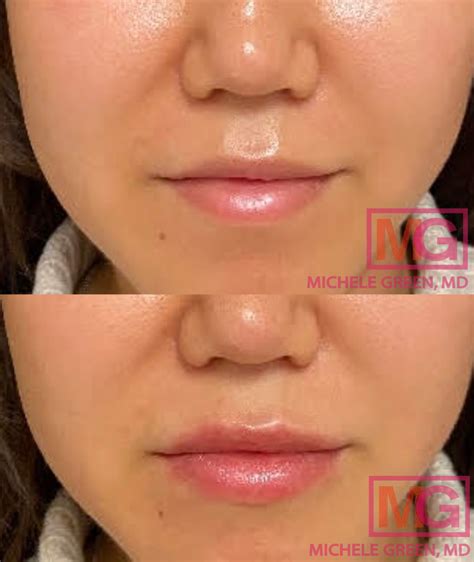 How To Get Rid Of White Spots On Lips After Filler Infoupdate Org