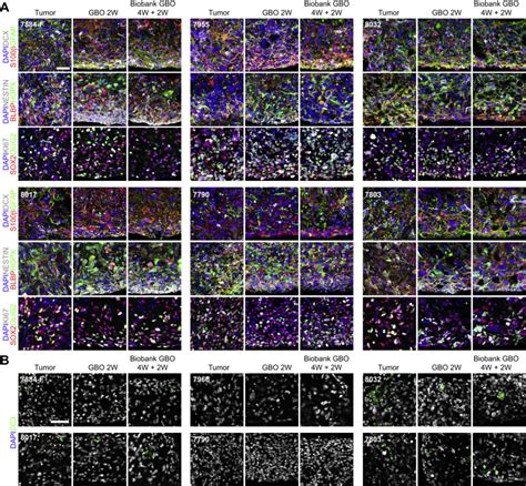 A Patient Derived Glioblastoma Organoid Model And Biobank Recapitulates