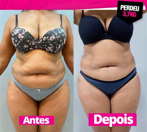 Virtuosa Estetica Jundiai Enzimas Antes E Depois Virtuosa Est Tica