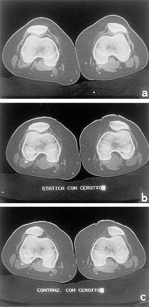 Figure 1 From The Effects Of Patellar Taping On Patellofemoral