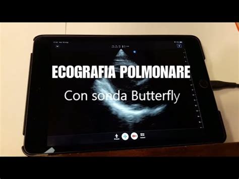 Ecografia Polmonare Per La Diagnosi Covid Youtube