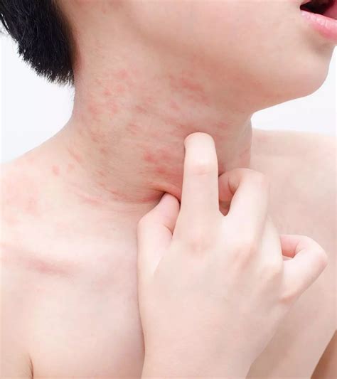 Skin Rashes In Children Causes And Treatment