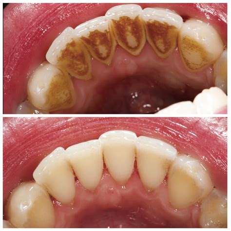 Regular Teeth Cleaning Vs Deep Cleaning Dental Office In