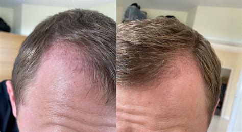 Hair Transplant Timeline What To Expect Treatment Rooms