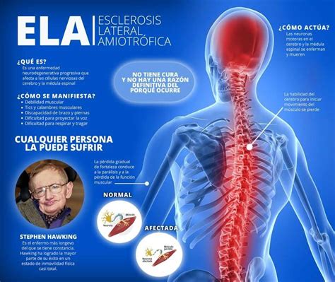 Ela Esclerosis Lateral Amiotr Fica Qu Es Causas S Ntomas