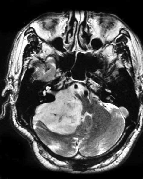 Epidermoid Cyst Cerebellopontine Angle Image