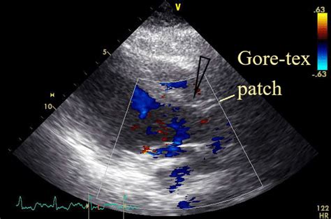 Postoperative Transthoracic Echocardiogram The View After Patch