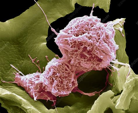 Cervical Cancer Cell Sem Stock Image C Science Photo Library