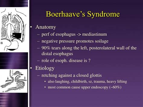 PPT - Boerhaave’s Syndrome PowerPoint Presentation - ID:1769909