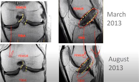 ACL MRI Evidence For The Perc ACLR Centeno Schultz Clinic