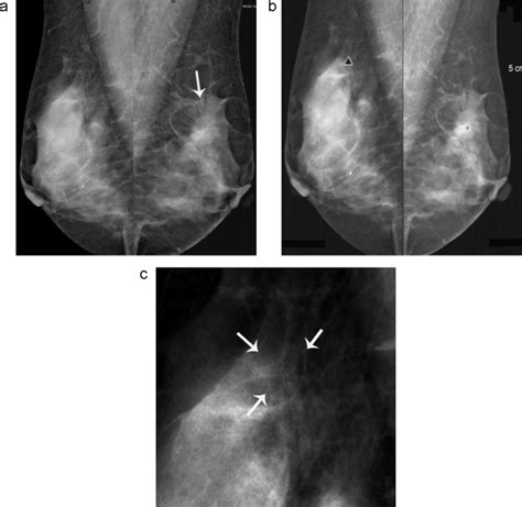 Computed Aided Diagnosis CAD In The Detection Of Breast Cancer