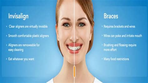 Best Middleburg Heights Invisalign Dentist Near Me Youtube