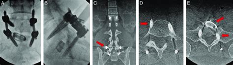 Preoperative Anterior Posterior A And Lateral B X Ray Radiographs Download Scientific