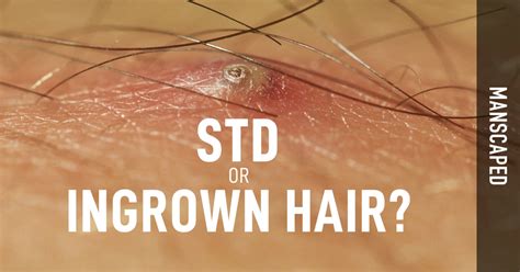 STD or Ingrown Hair? | Manscaped.com – MANSCAPED