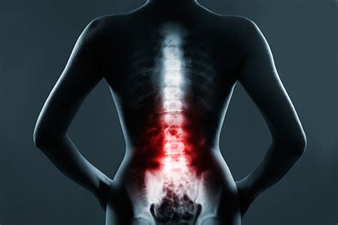 Do's and Don'ts after a Spinal Surgery