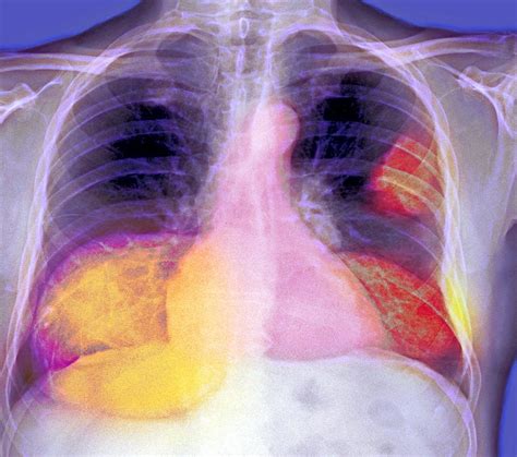 Lung Cancer X Ray Photograph By Du Cane Medical Imaging Ltd